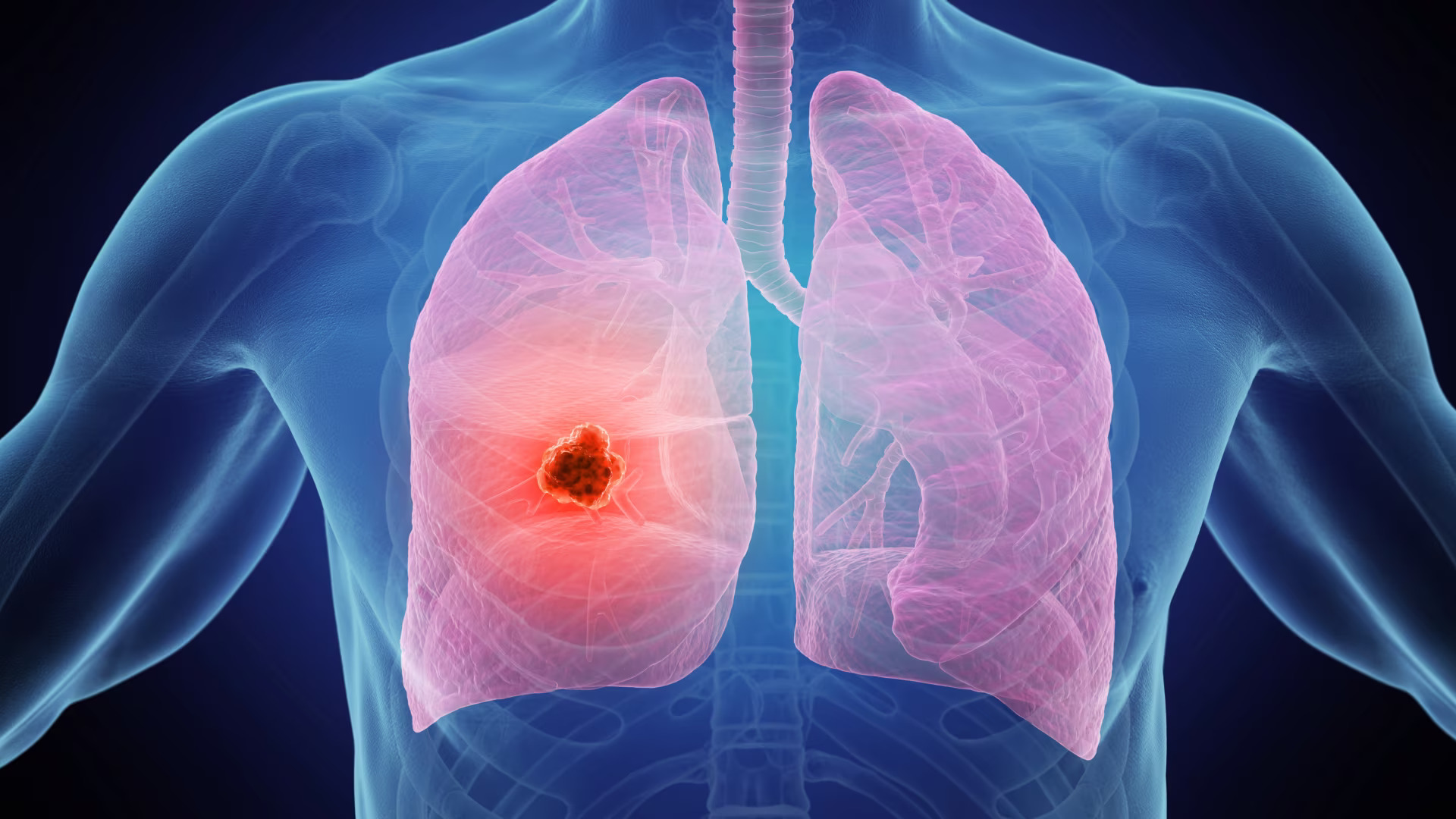 Lung Cancer Screening