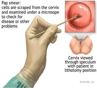 cervicalcancer